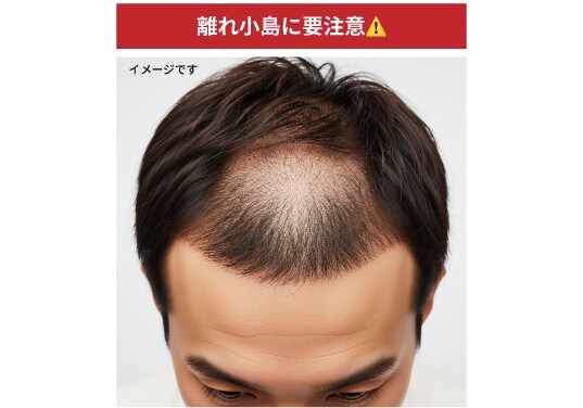 AGA治療薬を内服しなかった結果
