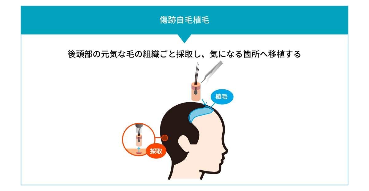 傷跡への植毛とは?