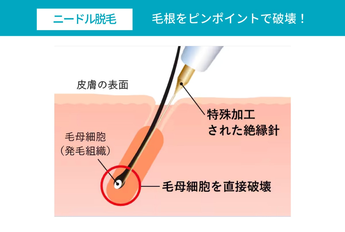 ニードル脱毛の仕組み