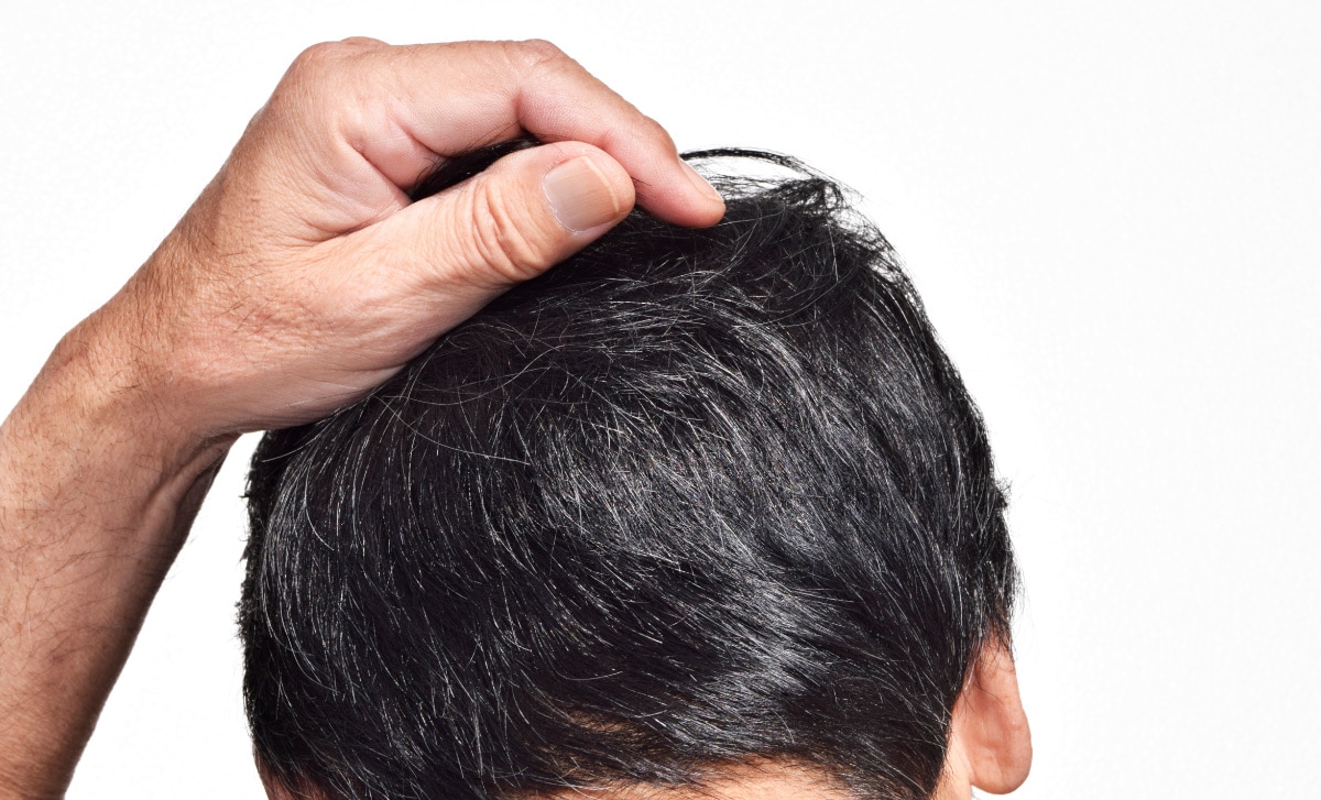 炎症性脱毛(えんしょうせいだつもう)