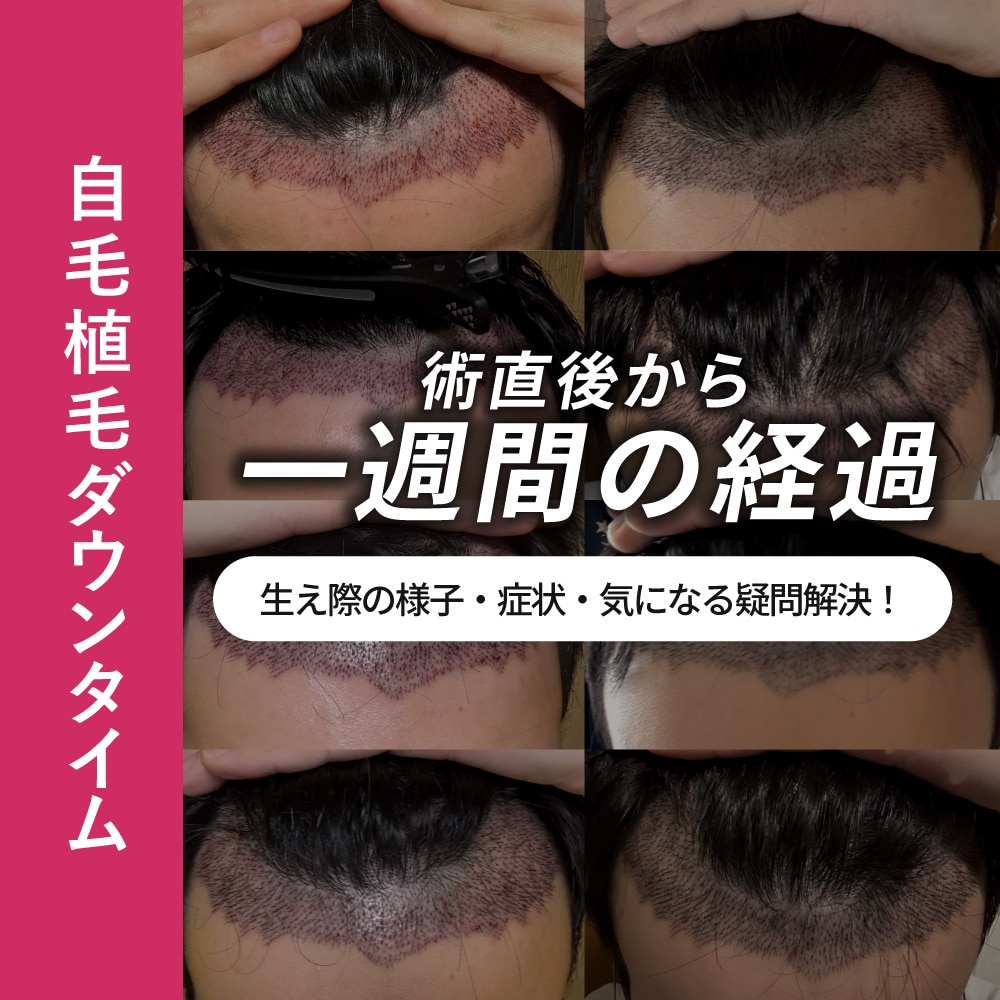 自毛植毛術直後から一週間の経過