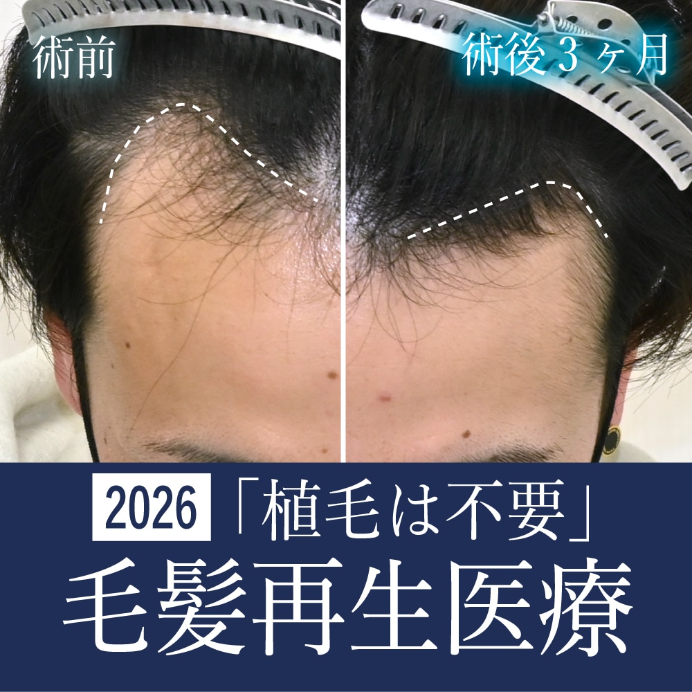 【2026年】植毛を考える前に！毛髪再生医療（メソセラピー）で地肌の透け感を劇的改善する新常識