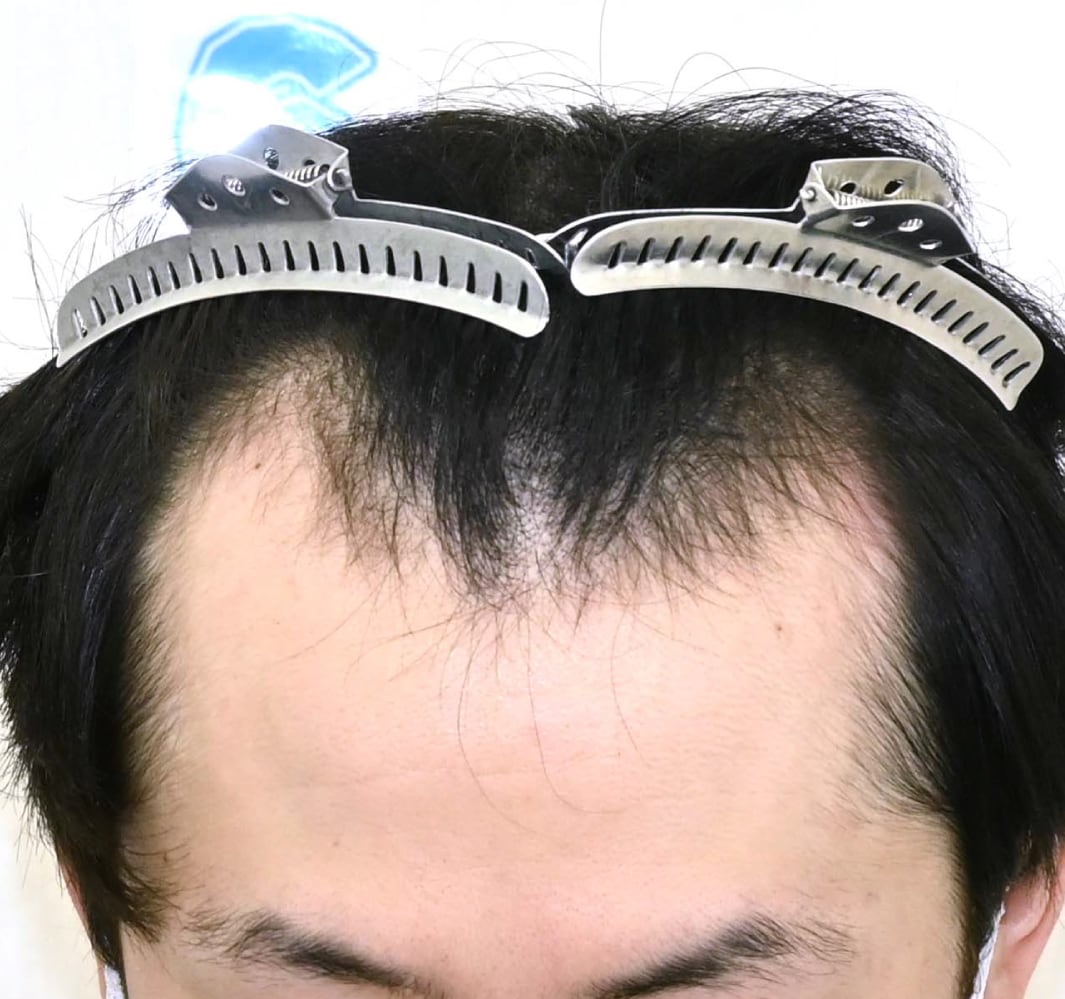 自毛植毛 施術前
