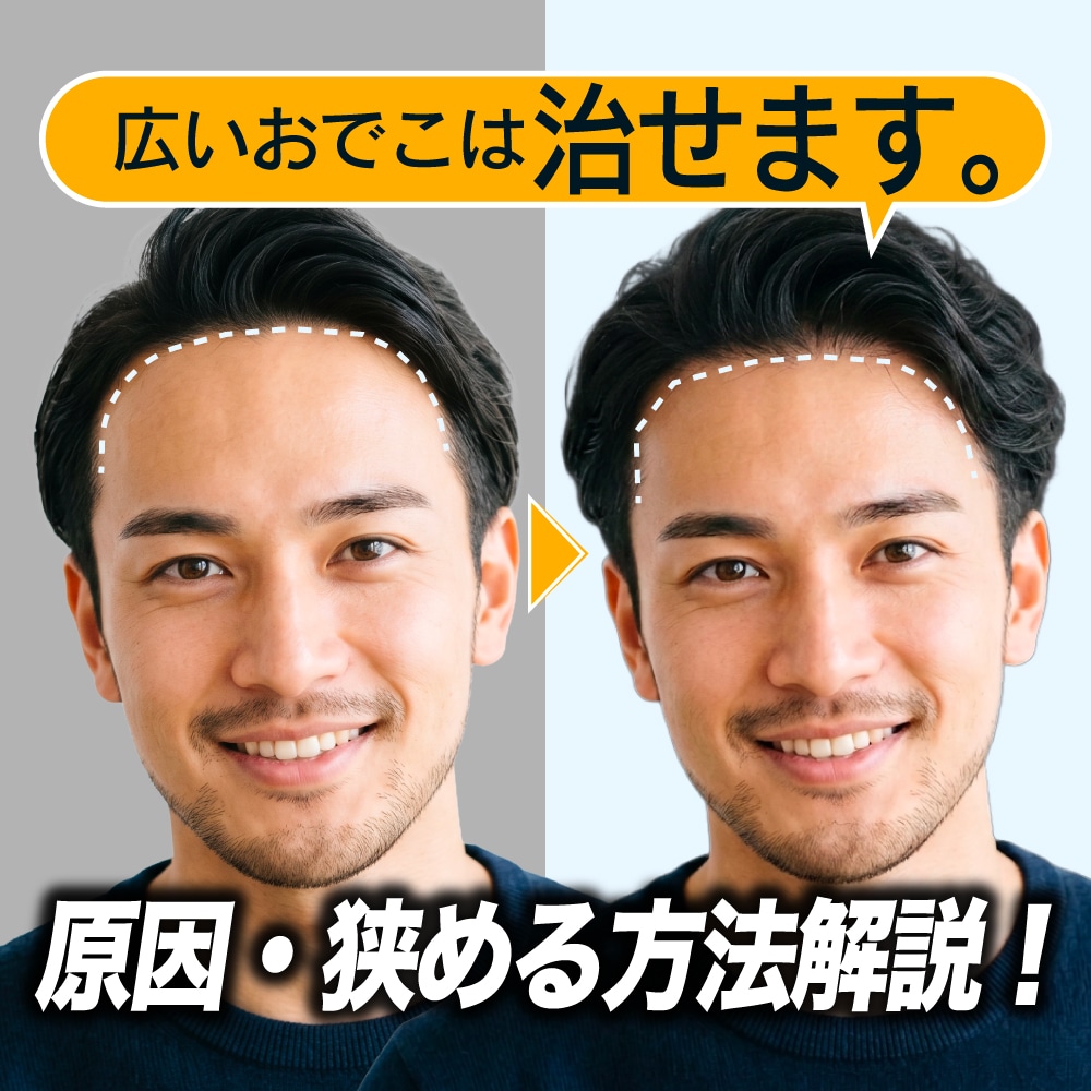 おでこを狭くする方法と広い原因を解説！｜ 仙台駅東口徒歩5分