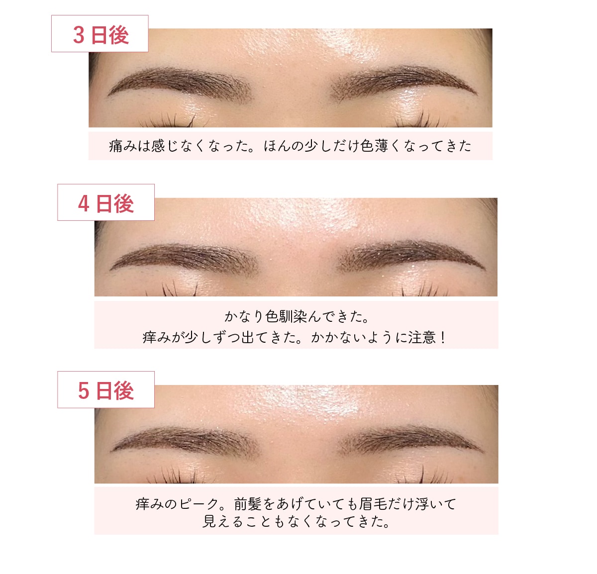 3日目から5日目：かさぶたの発生と痒み