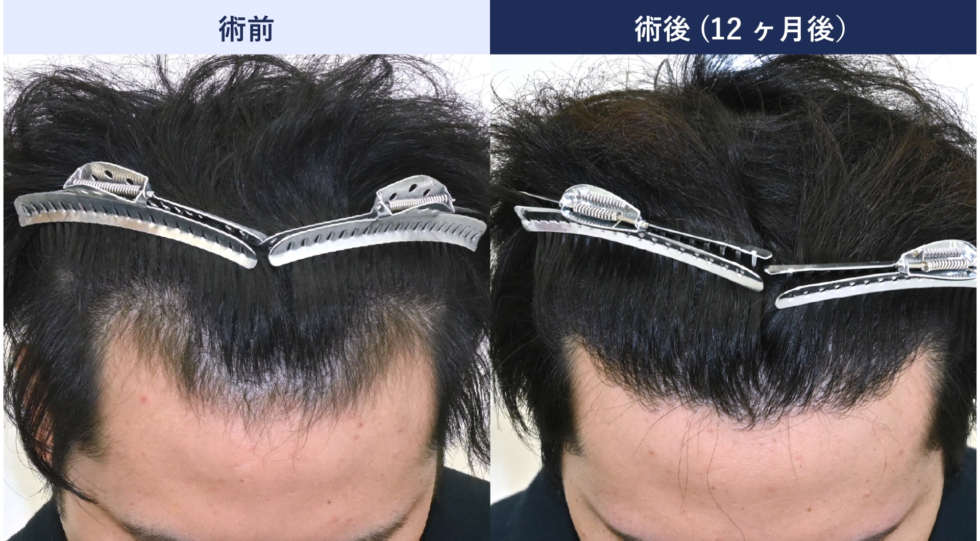 生え際(M字部分)のコンプレックスを自毛植毛で解消