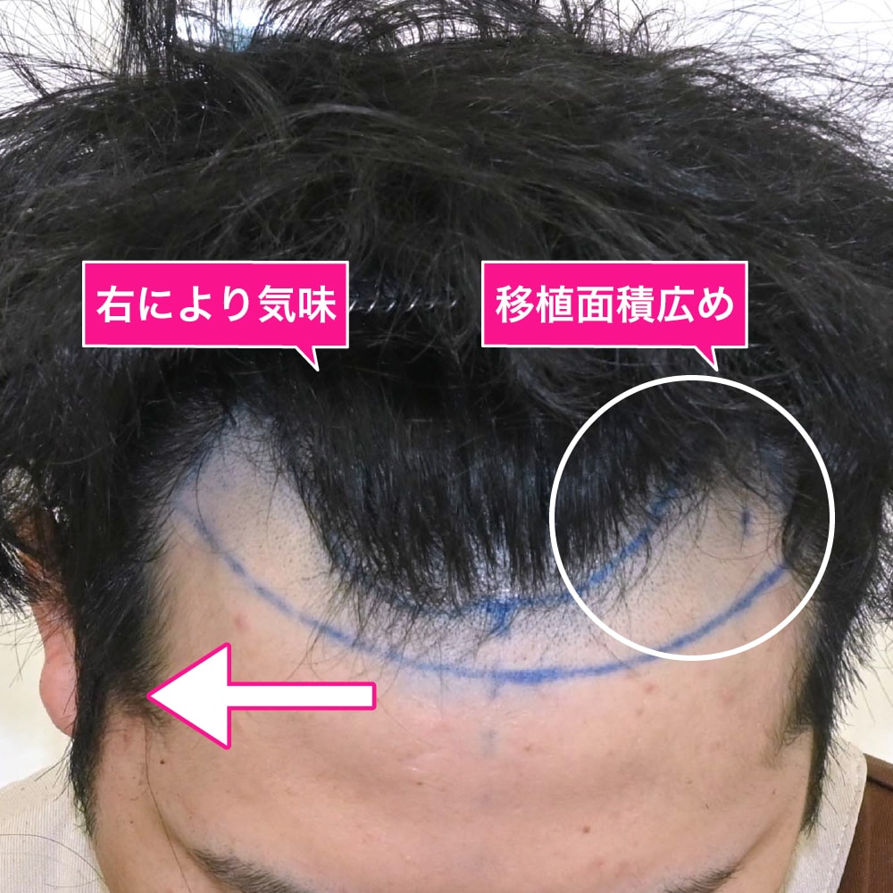 左右差と髪質に合わせた1500グラフトのノンシェーブン植毛
