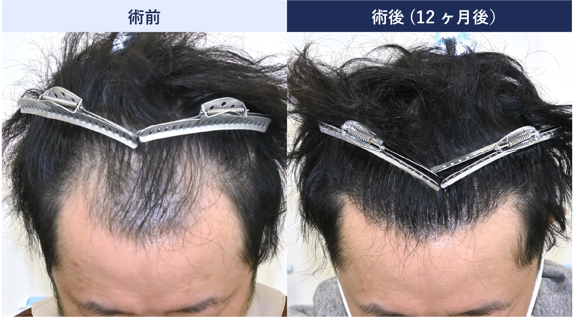 M字だけでなく中央も下げる自然なライン作り