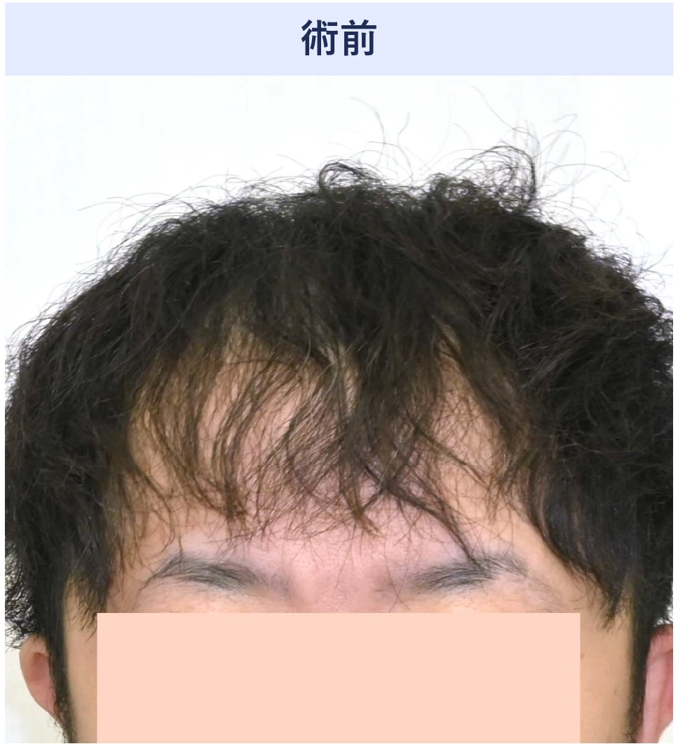 髪を前に持ってきて隠す「透け透け前髪」の限界