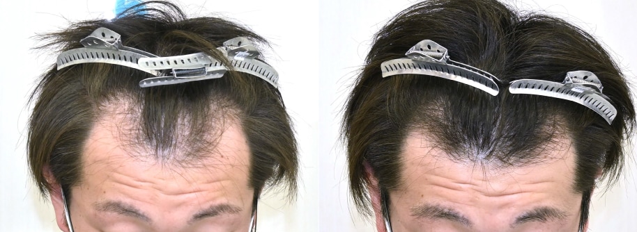 【AGA薄毛治療】30代男性 AGA治療薬の内服+毛根再生注射+臍帯幹細胞上清液メソ12回