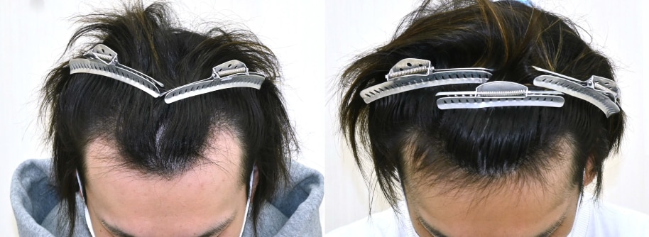 AGA治療薬+自毛植毛の症例写真 治療前と治療12ヶ月後の比較