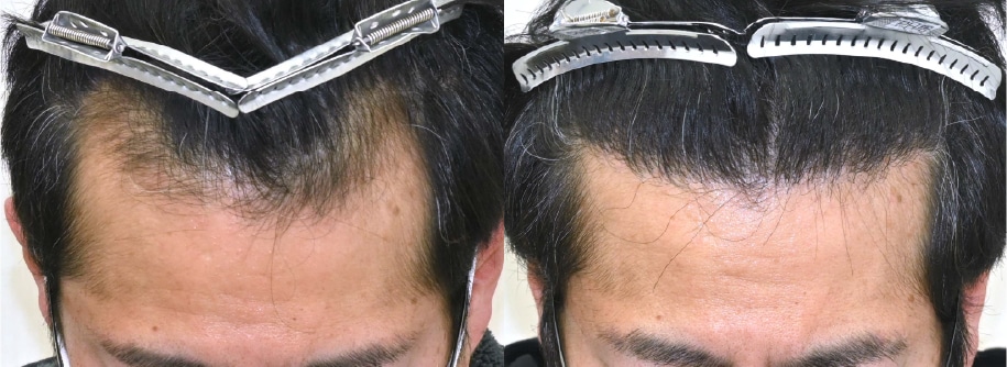 自毛植毛+AGA治療薬の症例写真 治療前と治療12ヶ月後の比較