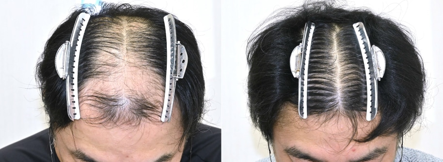 毛根再生注射+自毛植毛+AGA治療薬の症例写真 治療前と治療6ヶ月後の比較