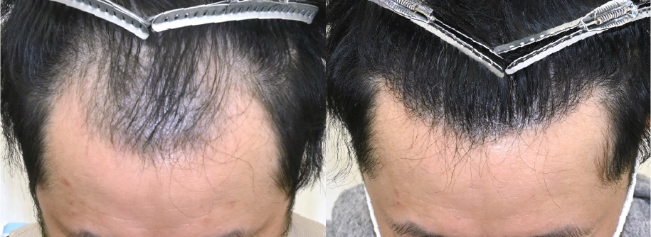 自毛植毛＋AGA治療薬の症例写真 治療前と治療12ヶ月後の比較