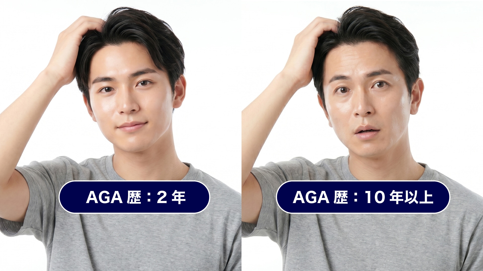 ① AGAの進行が進んでいる(重症度が高い)