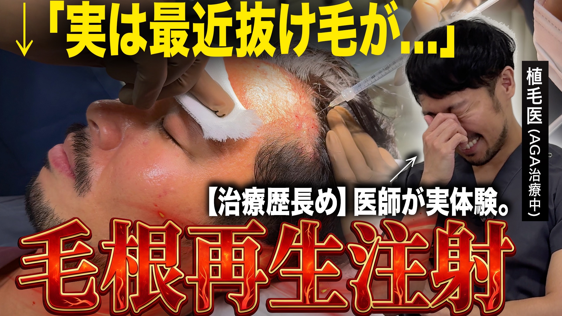 【仙台】薄毛注射の痛み・ダウンタイム検証！医師が体験した「毛根再生注射」を解説