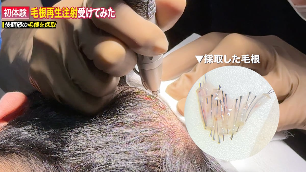 毛根の採取