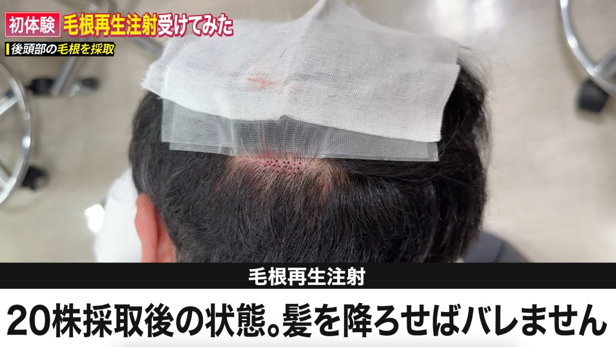 【短時間で治療可能】ダウンタイムも最小限な毛根再生注射