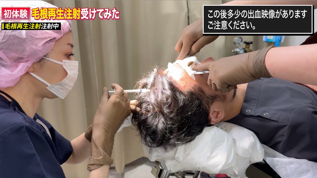 毛根再生注射を頭皮へ注射<br />