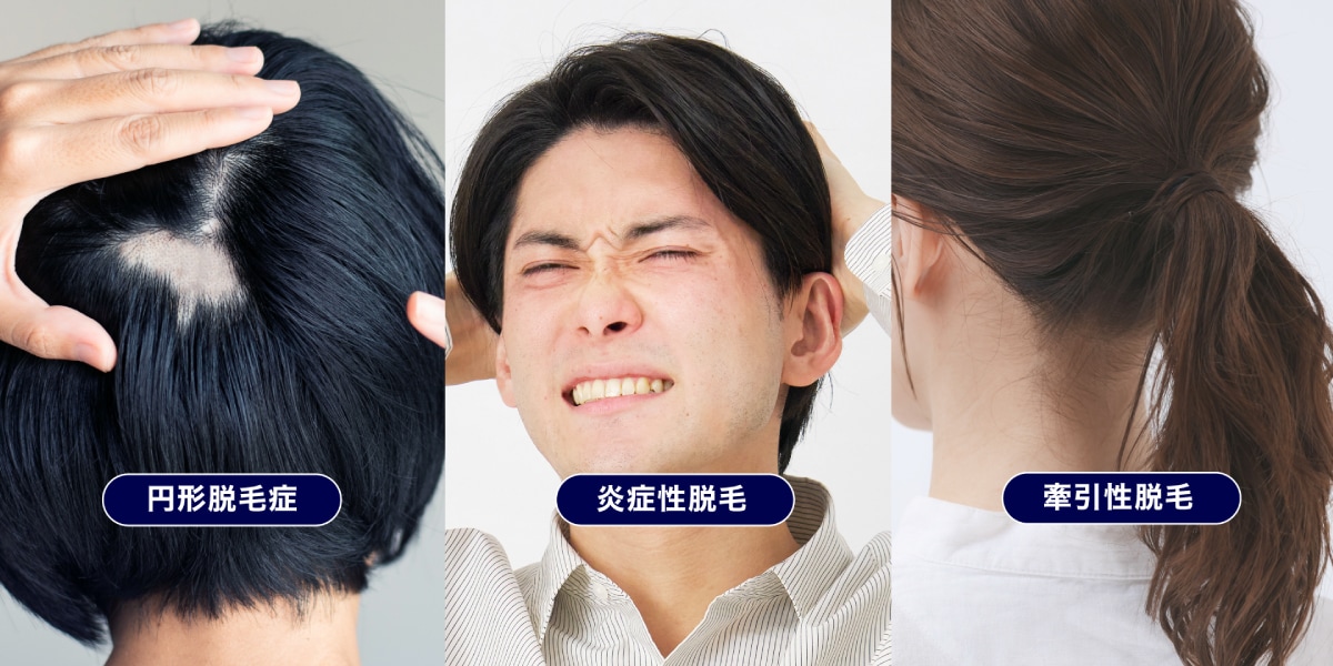 女性薄毛の原因