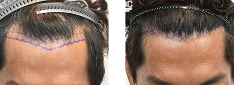 自毛植毛の症例写真 治療前と治療6ヶ月後の比較