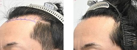 AGA治療薬+自毛植毛の症例写真 治療前と治療12ヶ月後の比較