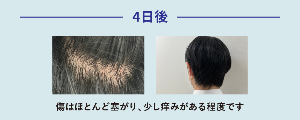 術後のケアについて