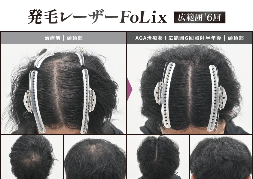 他院の注射治療では効果を実感できなかった30代男性のケース