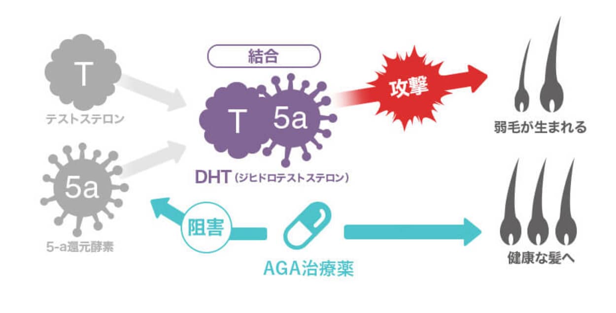 AGA(男性型脱毛症)とは?
