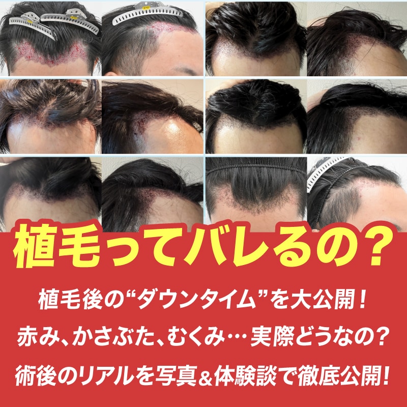 植毛後のダウンタイムは？術後の過ごし方・赤み・むくみ＆よくある質問まとめ