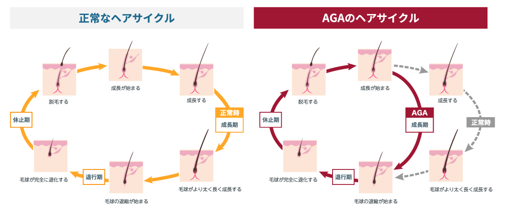 今、AGA治療を始めるべき理由