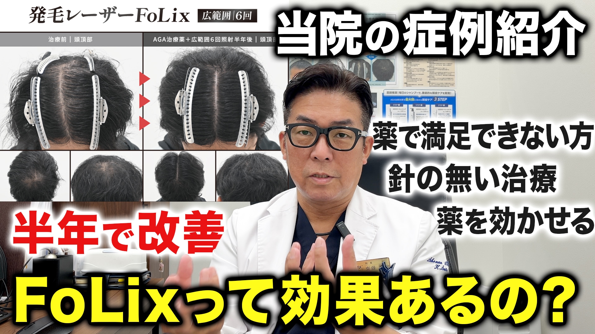 【解説】発毛レーザーFoLix（フォリックス）の効果を実際の写真から解説