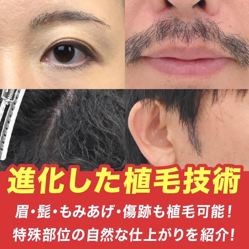 湘南AGAクリニックでは特殊部位の植毛も可能！【眉・髭・傷跡・もみあげ】進化した植毛技術を徹底解説！