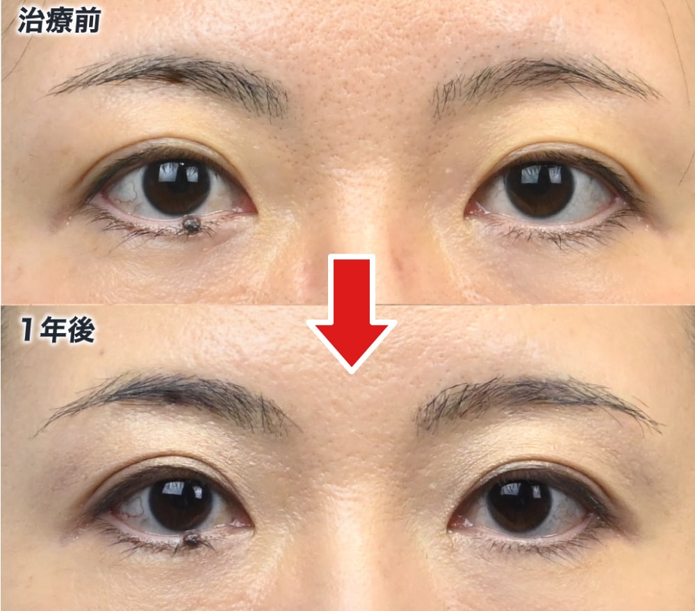 75グラフトの眉毛植毛