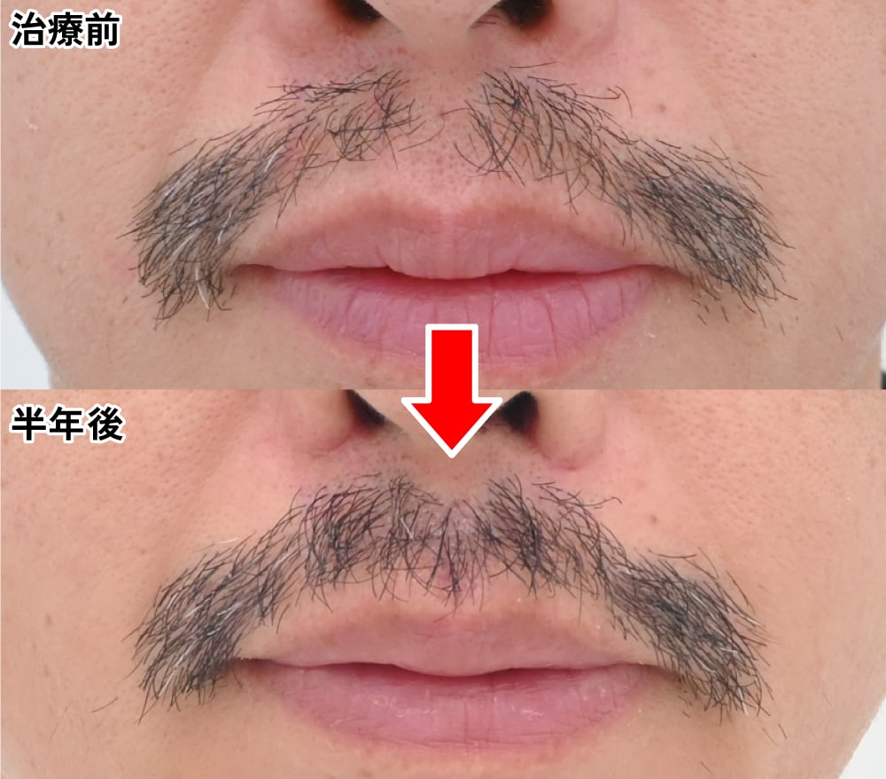 88グラフトの髭植毛