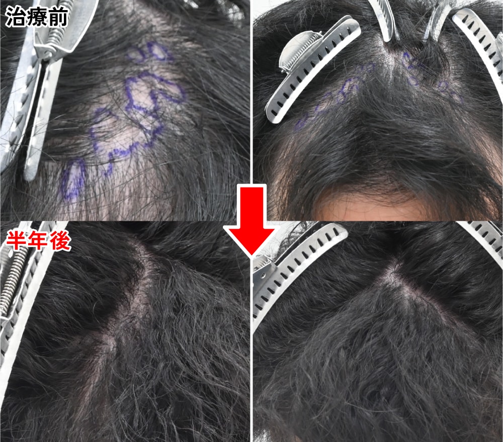 240グラフトの傷跡植毛