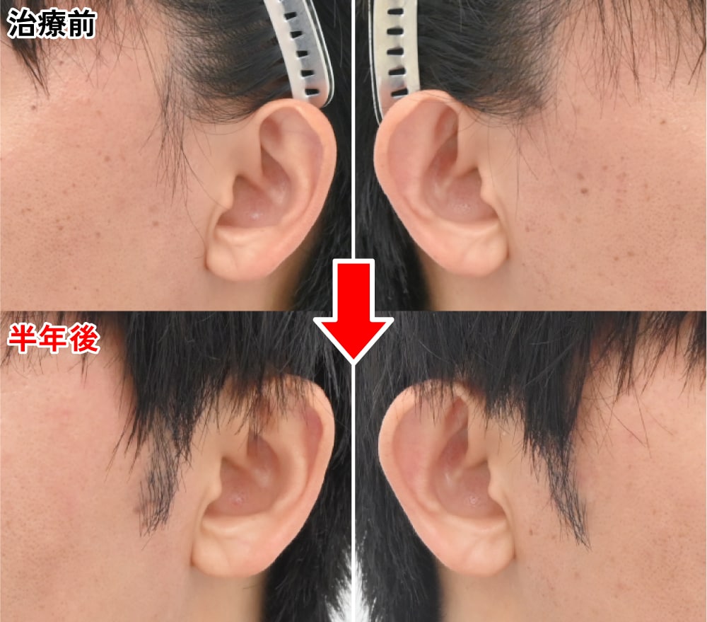 316グラフトのもみあげ植毛