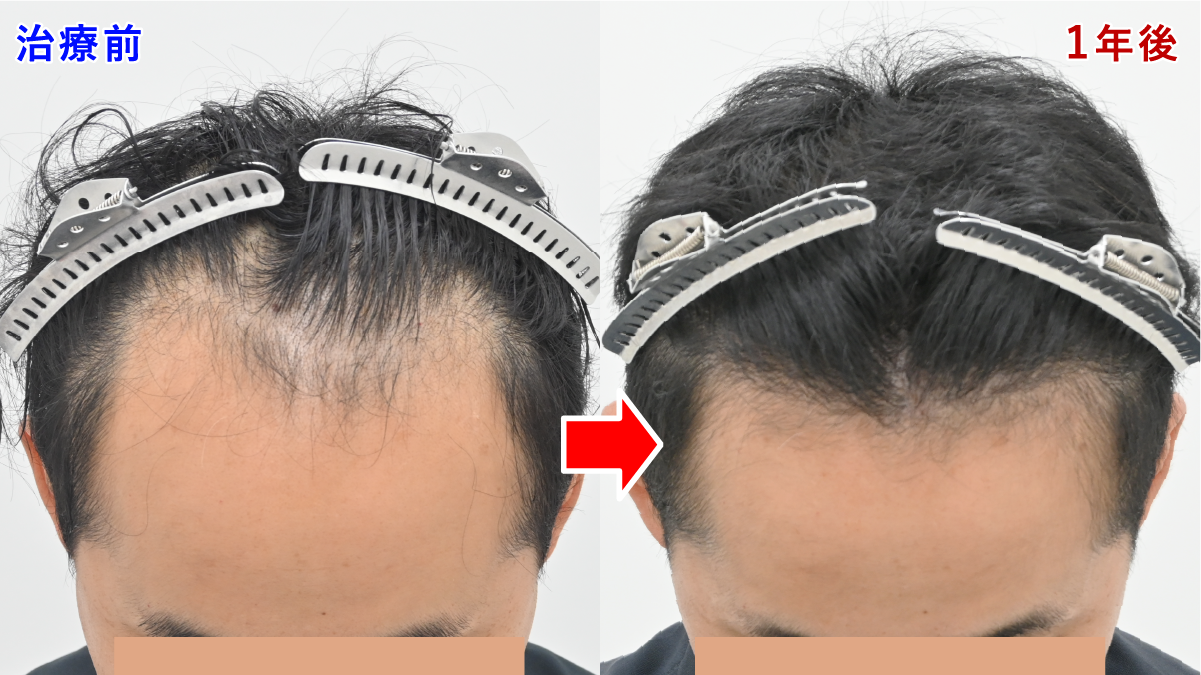 ノンシェーブン植毛 M字部分 症例