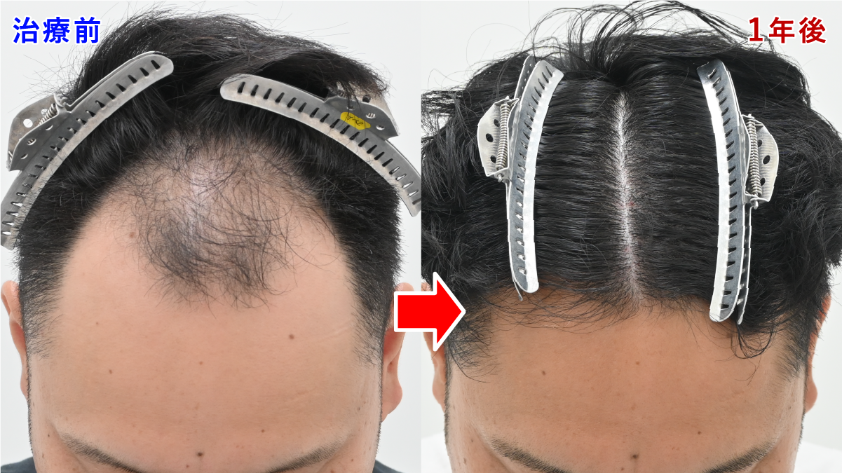 ノンシェーブン植毛 M字 症例