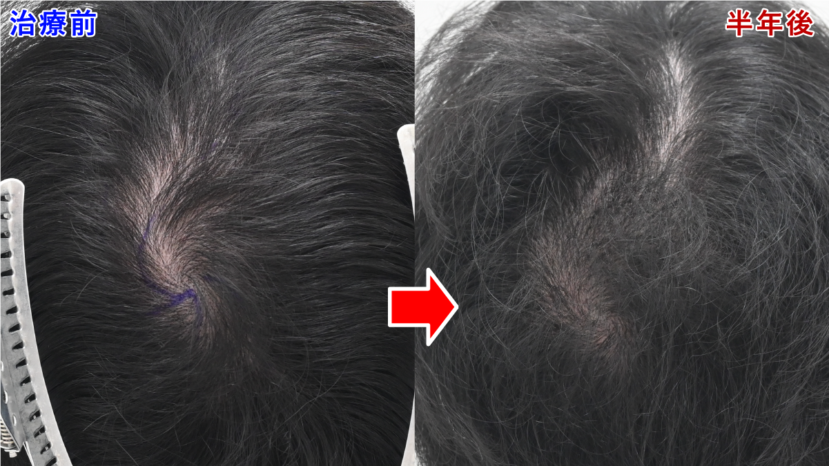 ノンシェーブン植毛 頭頂 症例