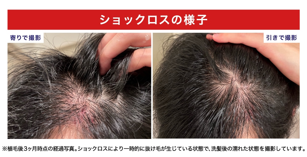 1〜3ヶ月|患者様が「一番つらかった」と感じたショックロスの時期