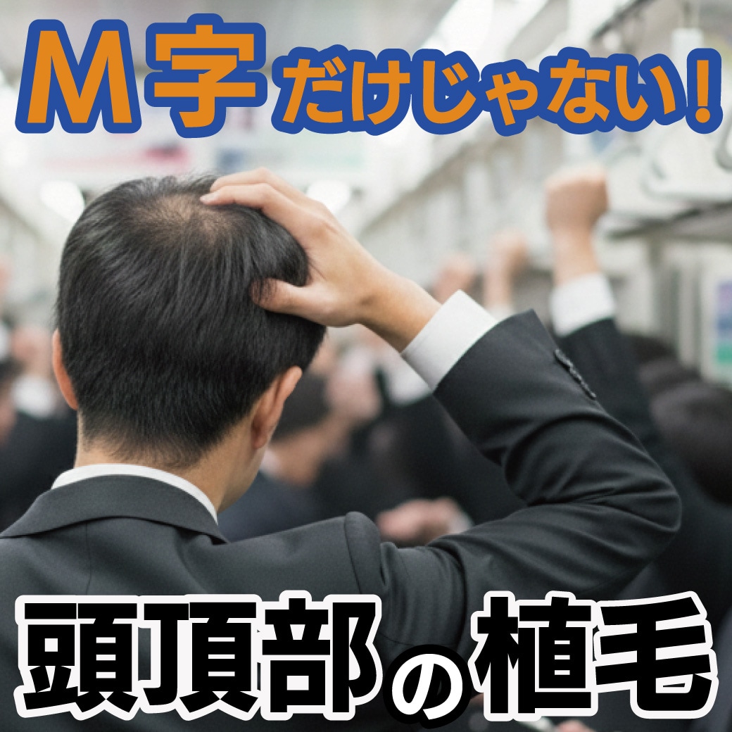 【東京・新宿】植毛はM字だけじゃない!頭頂部の植毛で後ろ姿に自信を!