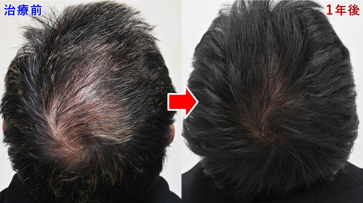ノンシェーブン植毛 頭頂部 症例