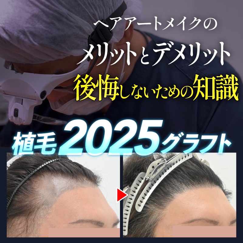 ヘアアートメイク植毛デメリットとメリット