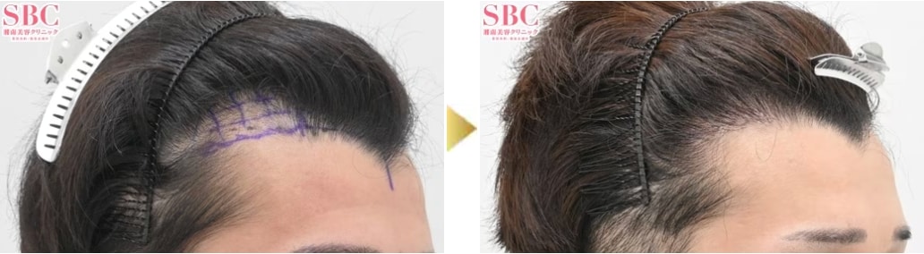 ちょこっと植毛