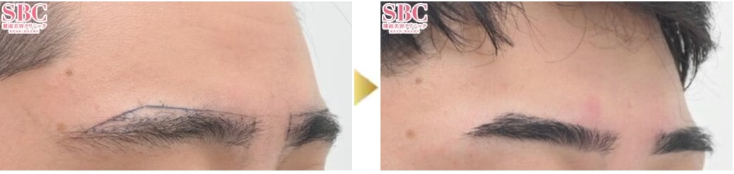 眉毛植毛
