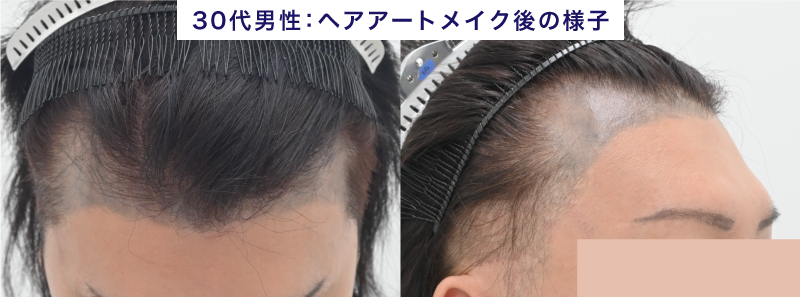ヘアアートメイクをした患者さんの悩み