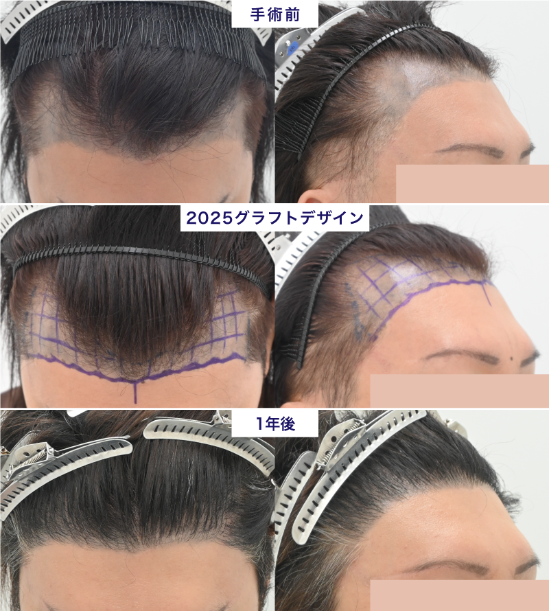 2025グラフトという選択