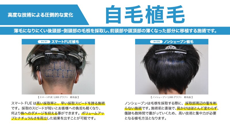 AGAキャンペーン