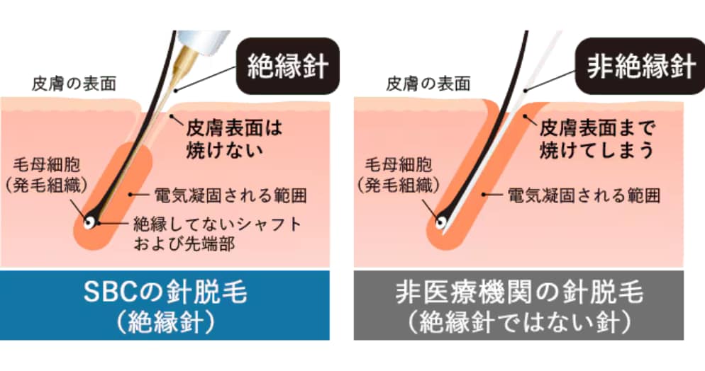 絶縁針とは?